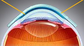 atlantis e-xcel sclera contact lenses